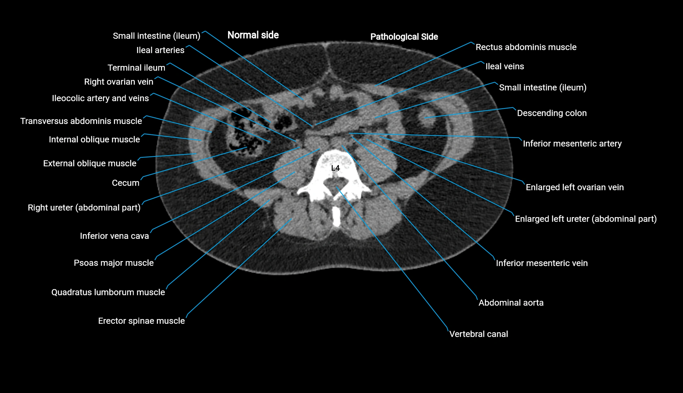 CT KUB axial cross sectional anatomy  radiology image -img-00201-00086.webp